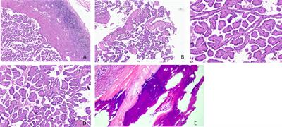 Papillary renal neoplasm with reverse polarity: A case report